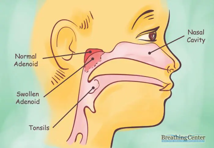 Nasal Cavity Removing the adenoids often leads to more serious defense reactions such as bronchial spasms