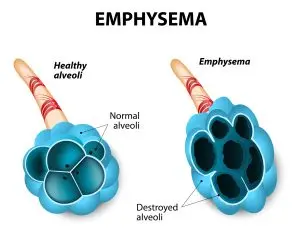 COPD and Buteyko Breathing Method