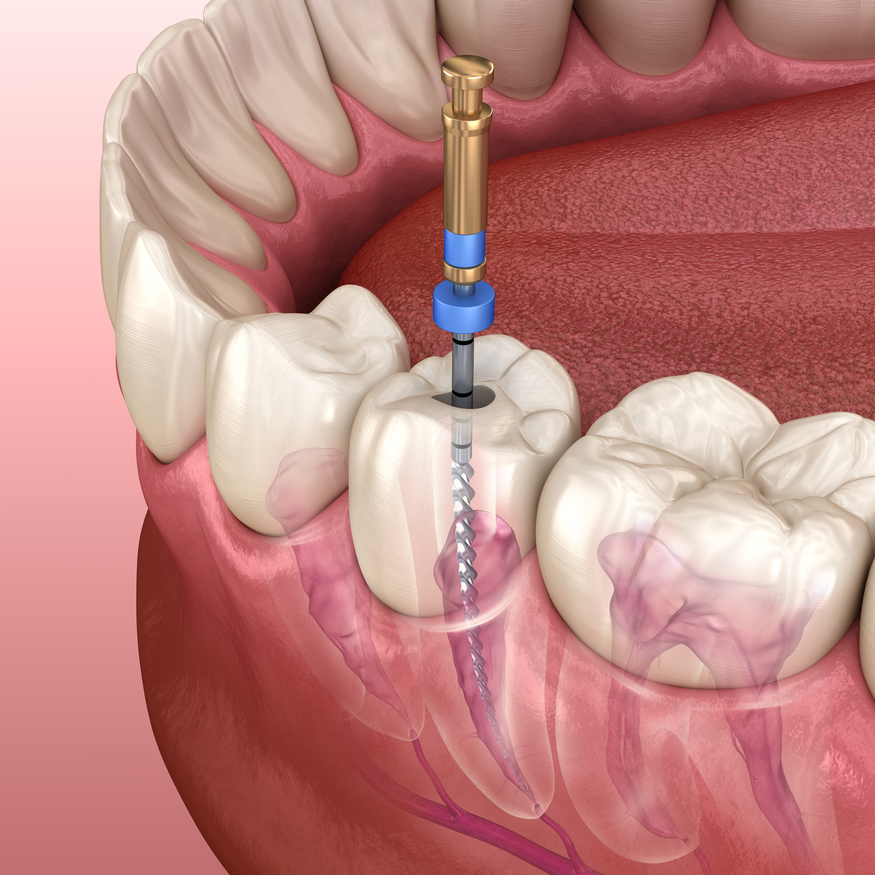 Root canal treatment on lower molar