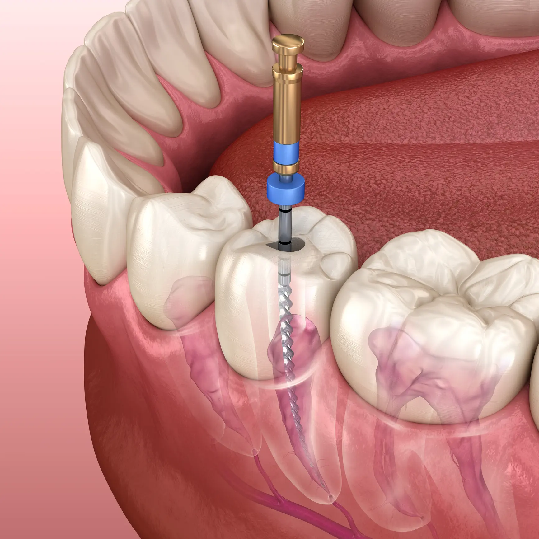 Root canal treatment on lower molar